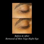 Photo of Scarless Mole and Skintag Removal